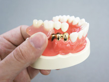 義歯（入れ歯）
