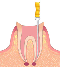 根管治療